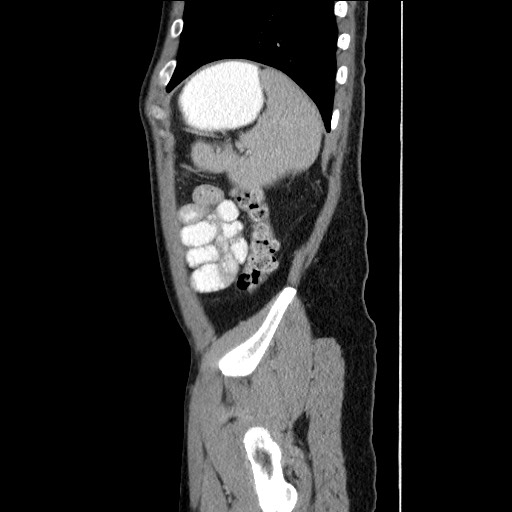 Closed-loop small bowel obstruction (Radiopaedia 73713-84509 B 138).jpg