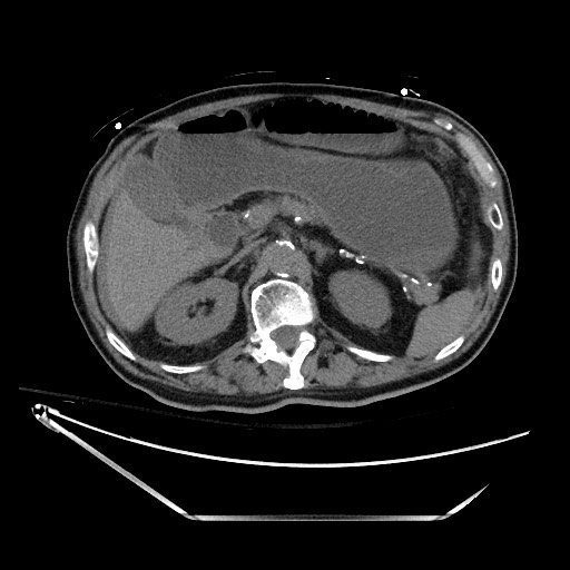 File:Closed loop obstruction due to adhesive band, resulting in small bowel ischemia and resection (Radiopaedia 83835-99023 Axial non-contrast 50).jpg