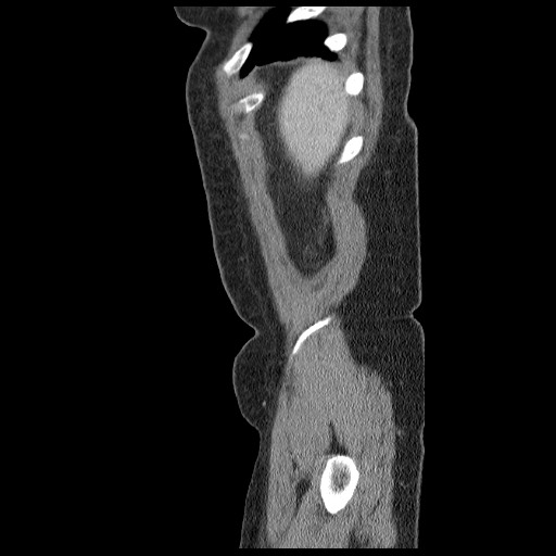 Closed loop small bowel obstruction (Radiopaedia 65403-74451 C 1).jpg