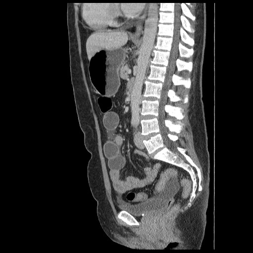Closed loop small bowel obstruction (Radiopaedia 65403-74451 C 54).jpg