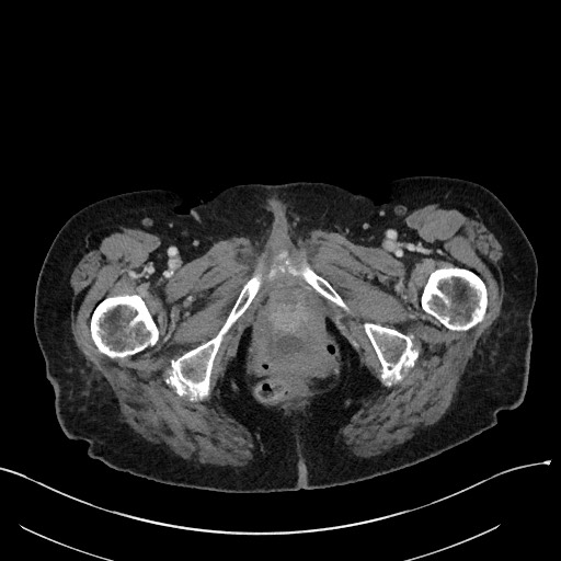 Closed loop small bowel obstruction - adhesions (Radiopaedia 59269-66611 A 140).jpg