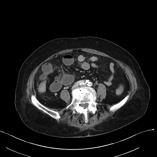 Closed loop small bowel obstruction - adhesions (Radiopaedia 59269-66611 A 82).jpg
