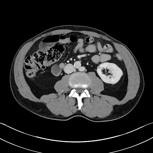 Closed loop small bowel obstruction - internal hernia (Radiopaedia 57806-64778 B 63).jpg