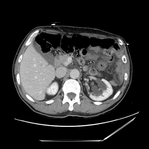 Closed loop small bowel obstruction - omental adhesion causing "internal hernia" (Radiopaedia 85129-100682 A 50).jpg
