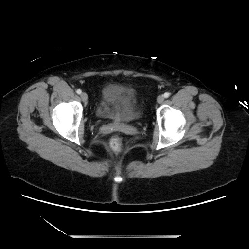 Closed loop small bowel obstruction due to adhesive bands - early and late images (Radiopaedia 83830-99014 A 143).jpg