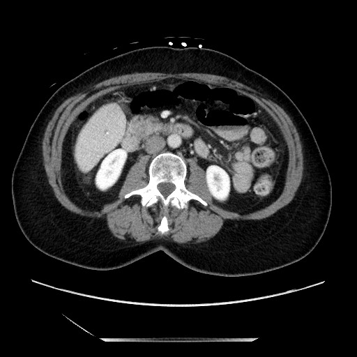 File:Closed loop small bowel obstruction due to adhesive bands - early and late images (Radiopaedia 83830-99014 A 65).jpg