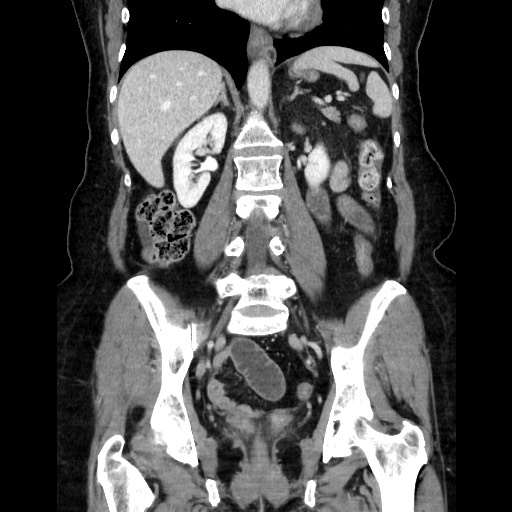 Closed loop small bowel obstruction due to adhesive bands - early and late images (Radiopaedia 83830-99015 B 78).jpg