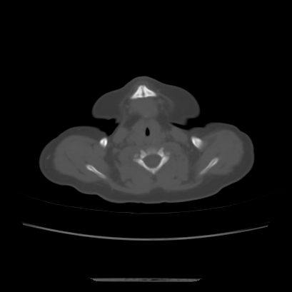 Cloverleaf skull (Radiopaedia 91901-109710 Axial bone window 13).jpg