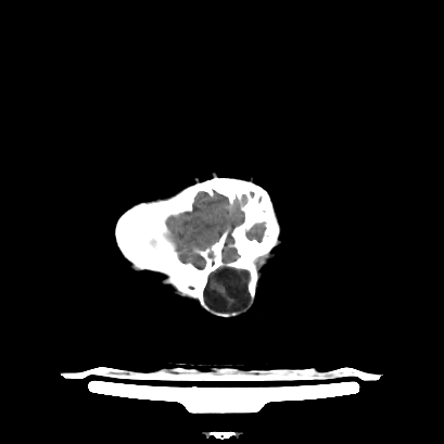 File:Cloverleaf skull (Radiopaedia 91901-109710 Axial non-contrast 135).jpg