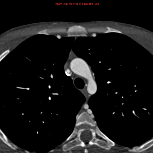 File:Coarctation of the aorta (Radiopaedia 12461-12697 A 70).jpg