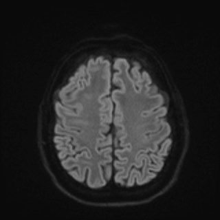 Cochlear incomplete partition type III associated with hypothalamic hamartoma (Radiopaedia 88756-105498 Axial DWI 71).jpg