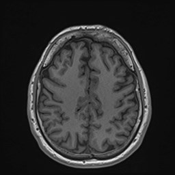 Cochlear incomplete partition type III associated with hypothalamic hamartoma (Radiopaedia 88756-105498 Axial T1 139).jpg