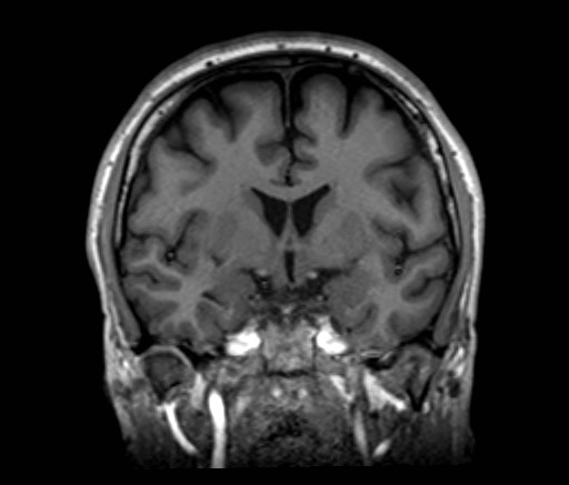 File:Cochlear incomplete partition type III associated with hypothalamic hamartoma (Radiopaedia 88756-105498 Coronal T1 37).jpg