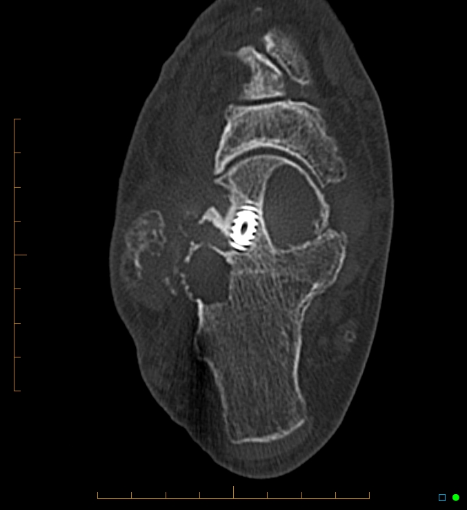 Collapsed total ankle replacement (Radiopaedia 17228-16932 Axial bone window 48).jpg