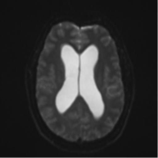 File:Colloid cyst (Radiopaedia 44510-48181 Axial DWI 17).png