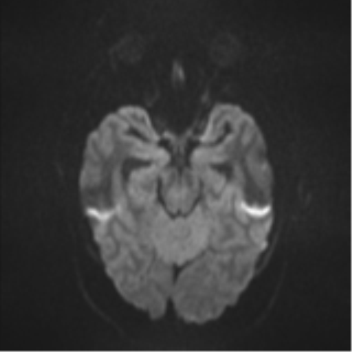 File:Colloid cyst (Radiopaedia 44510-48181 Axial DWI 37).png