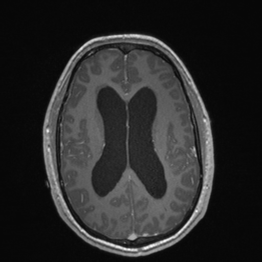 File:Colloid cyst (Radiopaedia 44510-48181 Axial T1 C+ 112).png