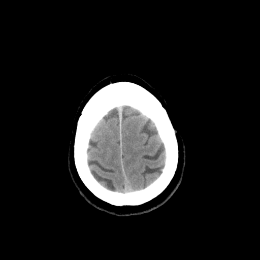 File:Colloid cyst (large) (Radiopaedia 34415-35734 Axial non-contrast 51).png