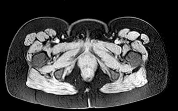 Colon adenocarcinoma with Krukenberg tumors, advanced pregnancy (Radiopaedia 67279-76645 A 4).jpg