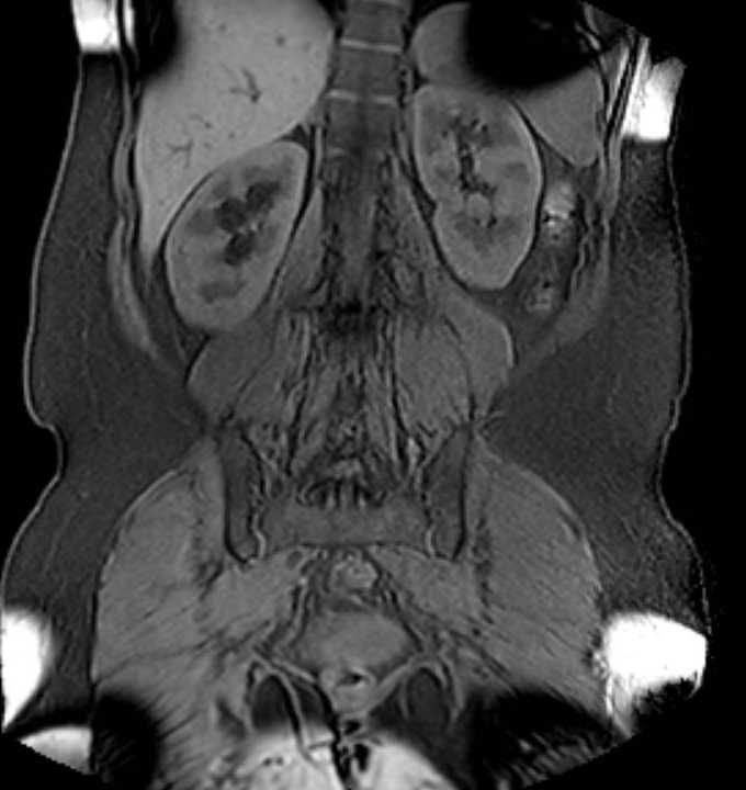 Colon adenocarcinoma with Krukenberg tumors, advanced pregnancy (Radiopaedia 67279-76645 E 72).jpg
