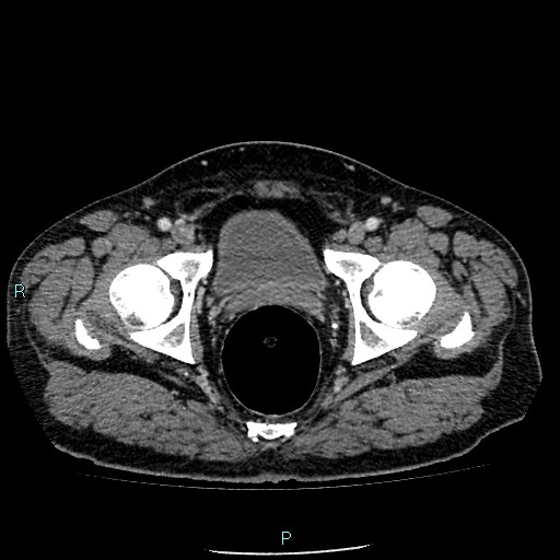 Colon adenocarcinoma with calcific liver metastasis (Radiopaedia 55745-62300 B 44).jpg