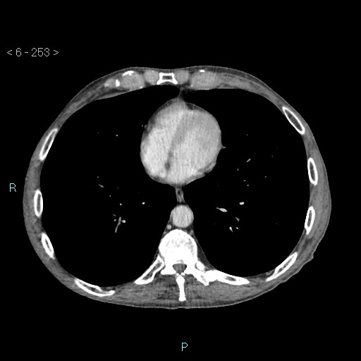 File:Colonic cancer (ultrasound and TC imaging) (Radiopaedia 50346-55713 B 253).jpg