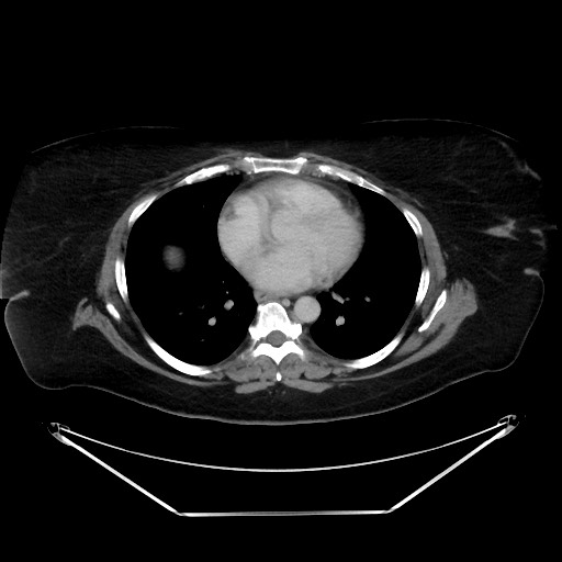 File:Colonic intussusception due to adenocarcinoma (Radiopaedia 86828-102987 A 6).jpg