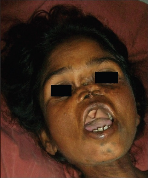 File:Congenital syphylis. Palatal perforation and partially edentulous upper jaw.png