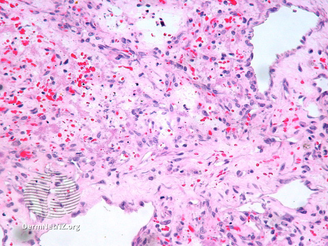 File:Figure 2 (DermNet NZ pathology-e-bacillary-angiomatosis-figure-2).jpg