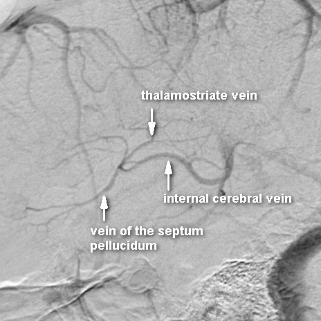 File:Internal cerebral vein (annotated DSA) (Radiopaedia 36175).jpg
