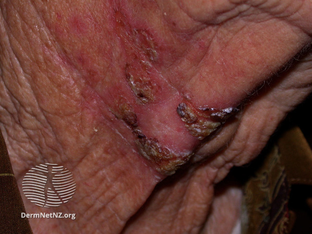File:Intraepidermal carcinoma (DermNet NZ lesions-scc-in-situ-2976).jpg