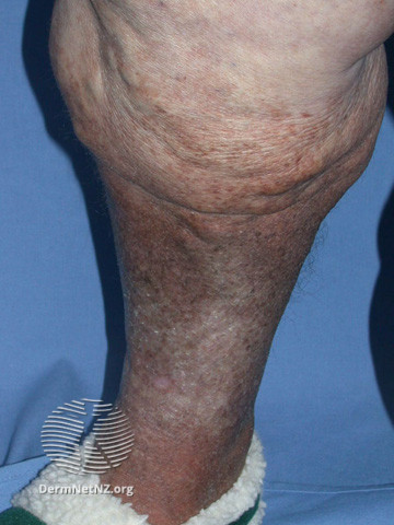 File:Lipodermatosclerosis (DermNet NZ vascular-lds4).jpg