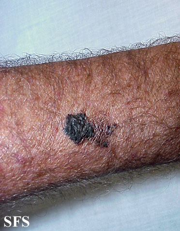 File:Melanoma (Dermatology Atlas 8).jpg