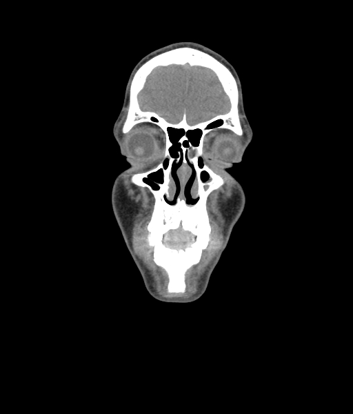 Nasal pyogenic granuloma (lobular capillary hemangioma) (Radiopaedia 85536-101244 Coronal non-contrast 58).jpg