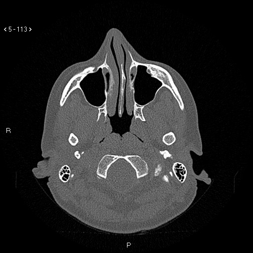 Nasolabial cyst (Radiopaedia 75125-86194 Axial bone window 74).jpg
