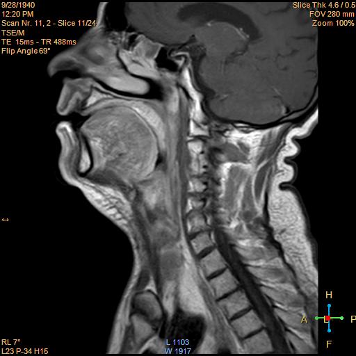 File:Nasopharyngeal carcinoma (Radiopaedia 22375-22403 Sagittal T1 C+ 7).jpg