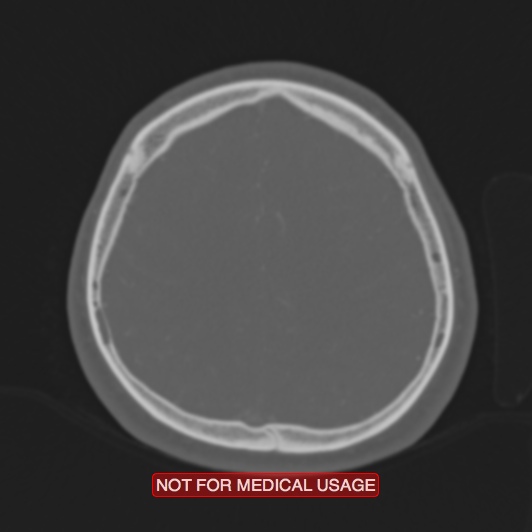 File:Nasopharyngeal carcinoma recurrence - skull base destruction (Radiopaedia 29107-29490 Axial bone window 28).jpg