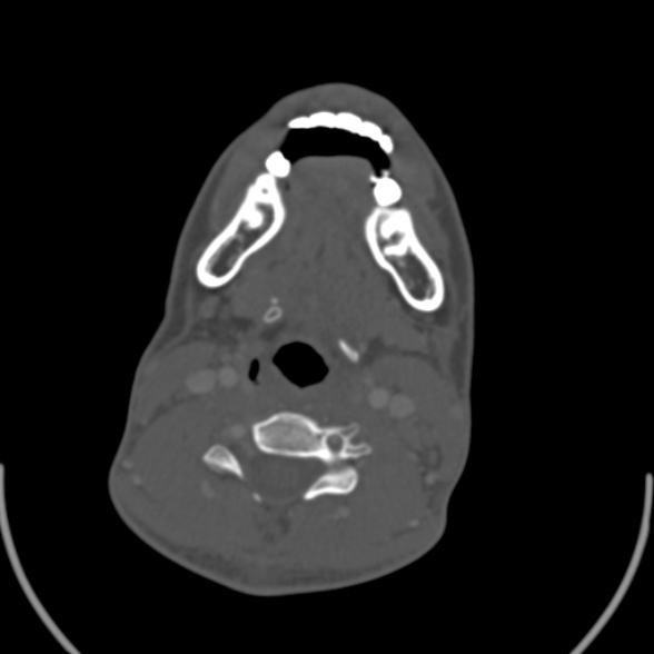 File:Nasopharyngeal carcinoma with skull base invasion (Radiopaedia 53415-59705 Axial bone window 126).jpg