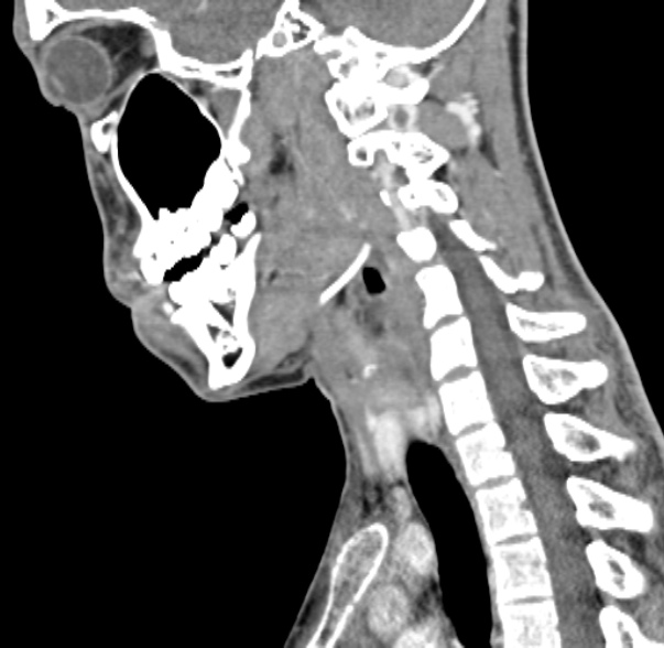 Nasopharyngeal carcinoma with skull base invasion (Radiopaedia 53415-59705 C 27).jpg