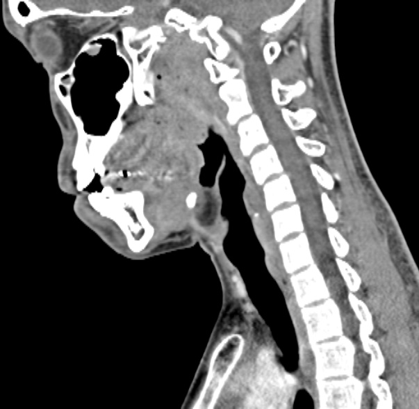 Nasopharyngeal carcinoma with skull base invasion (Radiopaedia 53415-59705 C 31).jpg