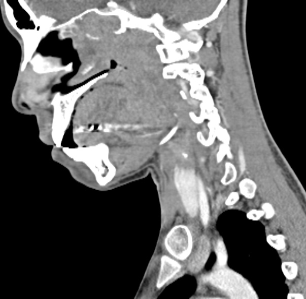 Nasopharyngeal carcinoma with skull base invasion (Radiopaedia 53415-59705 C 42).jpg