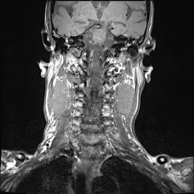 File:Nasopharyngeal carcinoma with skull base invasion (Radiopaedia 59258-66600 Coronal T1 11).jpg