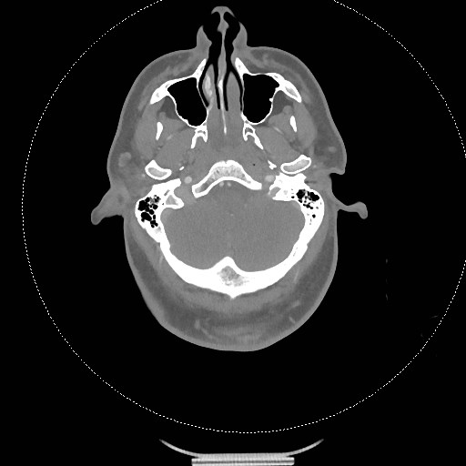 Neck CT angiogram (intraosseous vascular access) (Radiopaedia 55481-61945 B 259).jpg