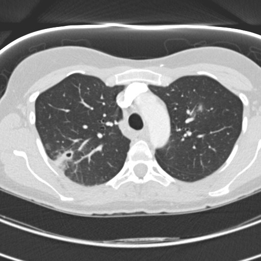 Necrobiotic pulmonary nodules - Crohn disease (Radiopaedia 20723-20631 Axial lung window 42).jpg