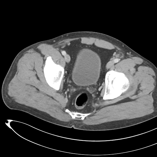File:Necrotizing pancreatitis with acute necrotic collections (Radiopaedia 38829-41012 B 76).png
