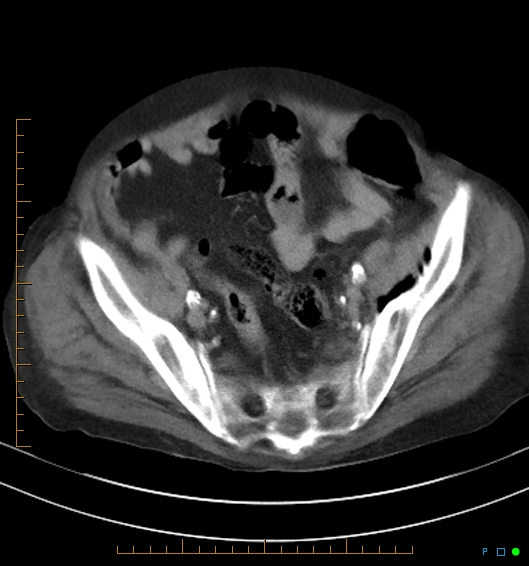 Necrotzing fasciitis due to a perforated adenocarcinoma of the splenic flexure (Radiopaedia 46930-51455 A 51).jpg