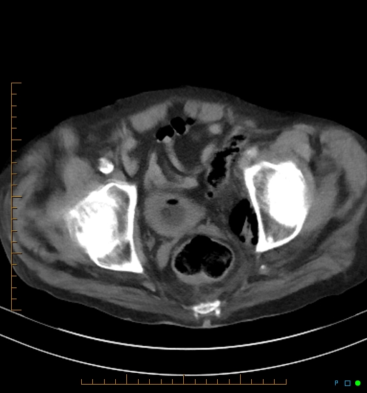 Necrotzing fasciitis due to a perforated adenocarcinoma of the splenic flexure (Radiopaedia 46930-51455 A 58).jpg