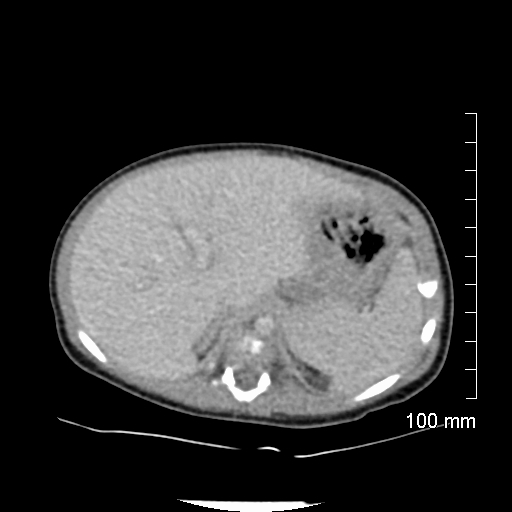 File:Neonatal neuroblastoma (Radiopaedia 56651-63438 Axial non-contrast 22).jpg