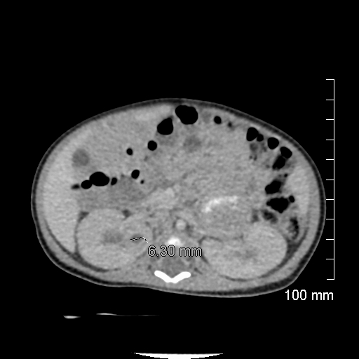 File:Neonatal neuroblastoma (Radiopaedia 56651-63438 Axial non-contrast 37).jpg