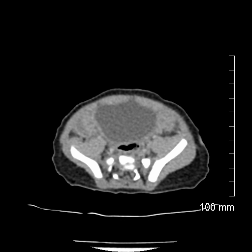 File:Neonatal neuroblastoma (Radiopaedia 56651-63438 Axial non-contrast 63).jpg